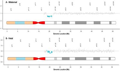 Positive cfDNA screening results for 22q11.2 deletion syndrome—Clinical and laboratory considerations